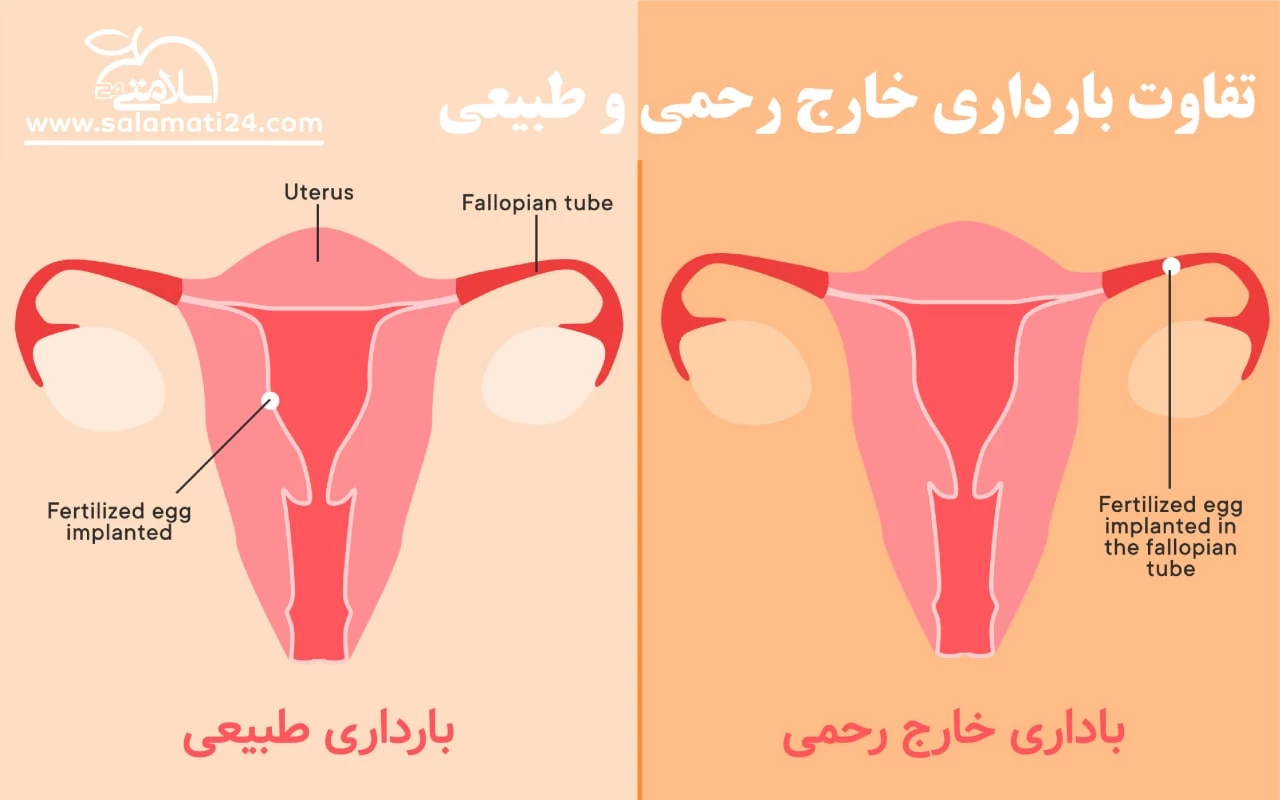 تمام آنچه که باید در مورد بارداری خارج از رحم بدانید