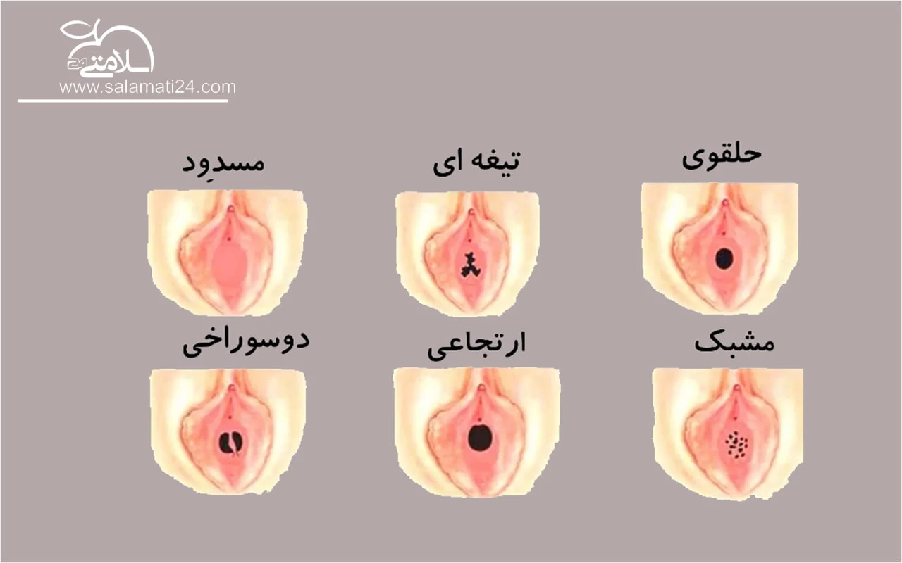 تمام نکاتی که باید در خصوص پرده بکارت (هایمن) بدانید 