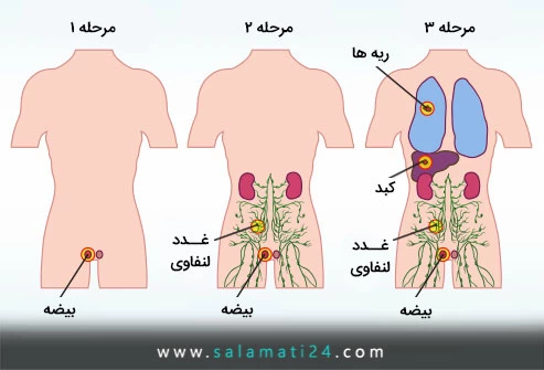 آزمایشات تعیین مرحله سرطان