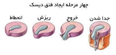 فتق دیسک