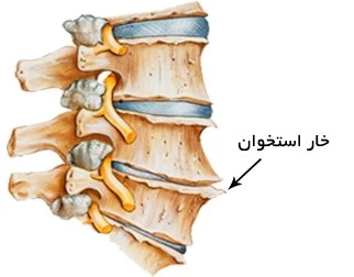 خار استخوان