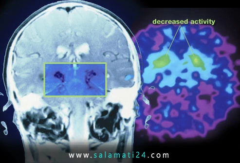 مراحل پیشرفت پارکینسون