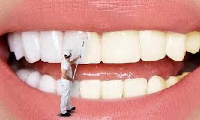 بلیچینگ دندانها(سفید کردن دندانها)